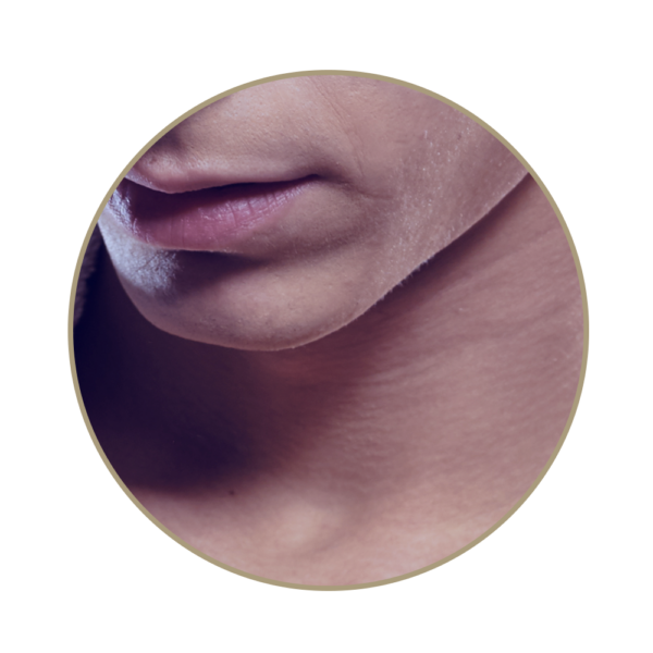 CoolSculpting