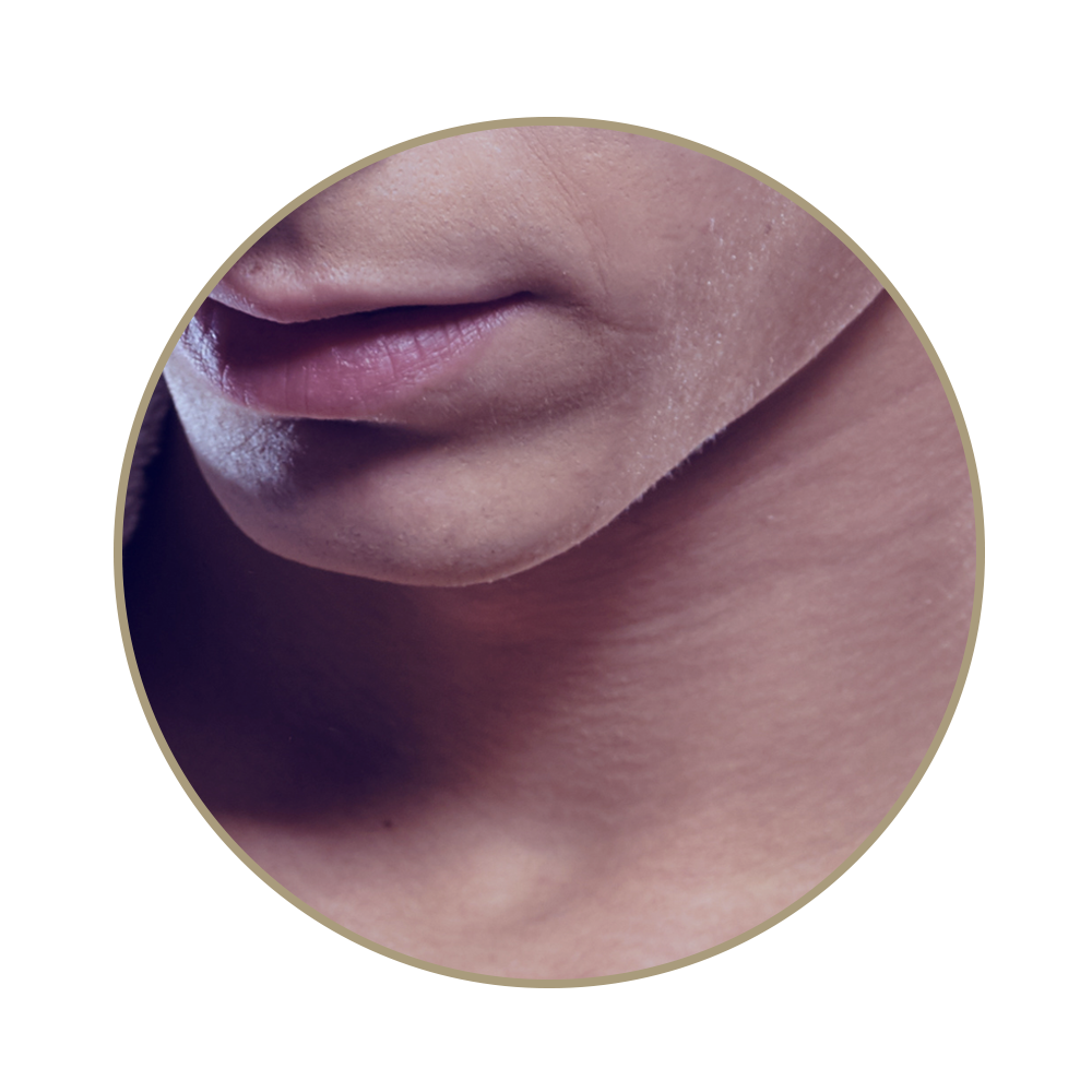 CoolSculpting