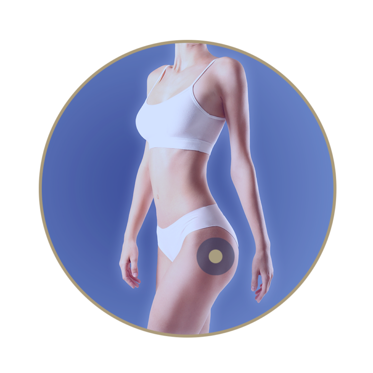 LA CELLULITE